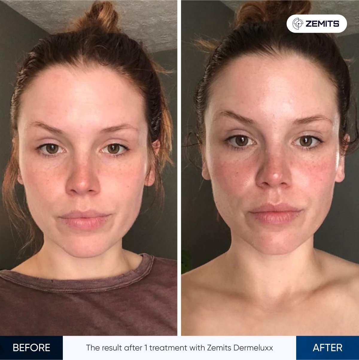 Zemits_Dermeluxx-2